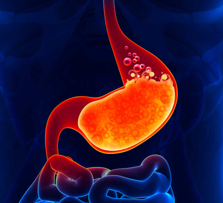 Auto-Brewery Syndrome (Gut Fermentation Syndrome)