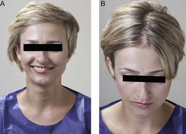 Parry-Romberg Syndrome (Progressive Hemifacial Atrophy)
