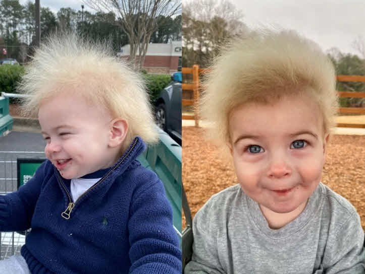 Uncombable Hair Syndrome