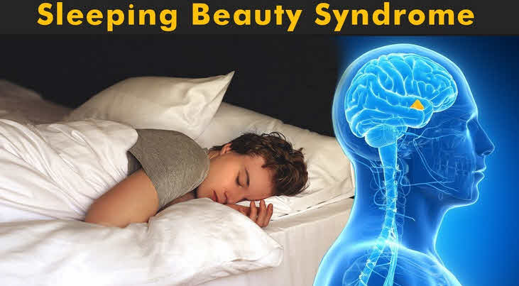 Kleine-Levin Syndrome (Sleeping Beauty Syndrome)