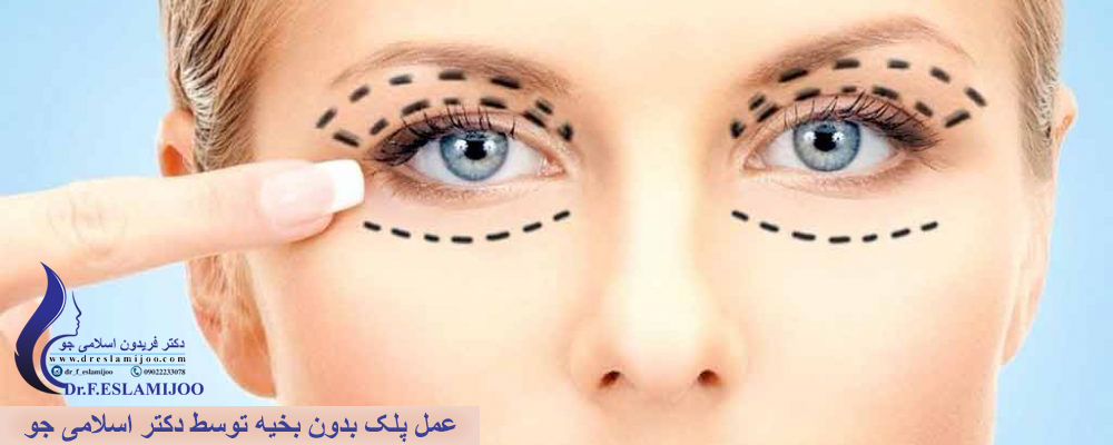 عمل پلک بدون بخیه توسط دکتر اسلامی جو