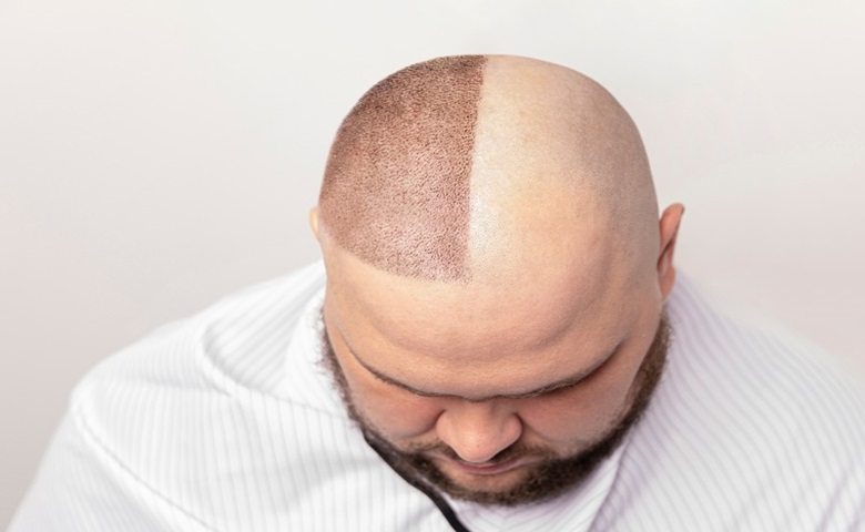 ویژگیهای بهترین کلینیک کاشت مو