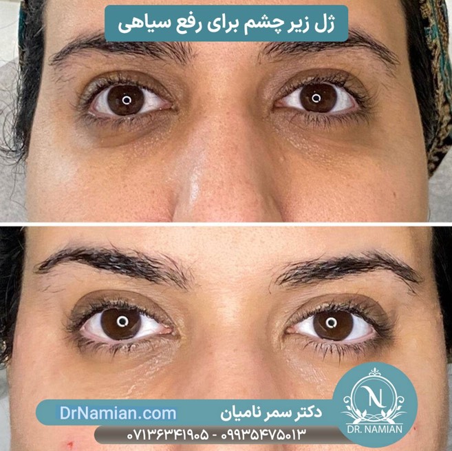 تزریق فیلر زیر چشم در شیراز