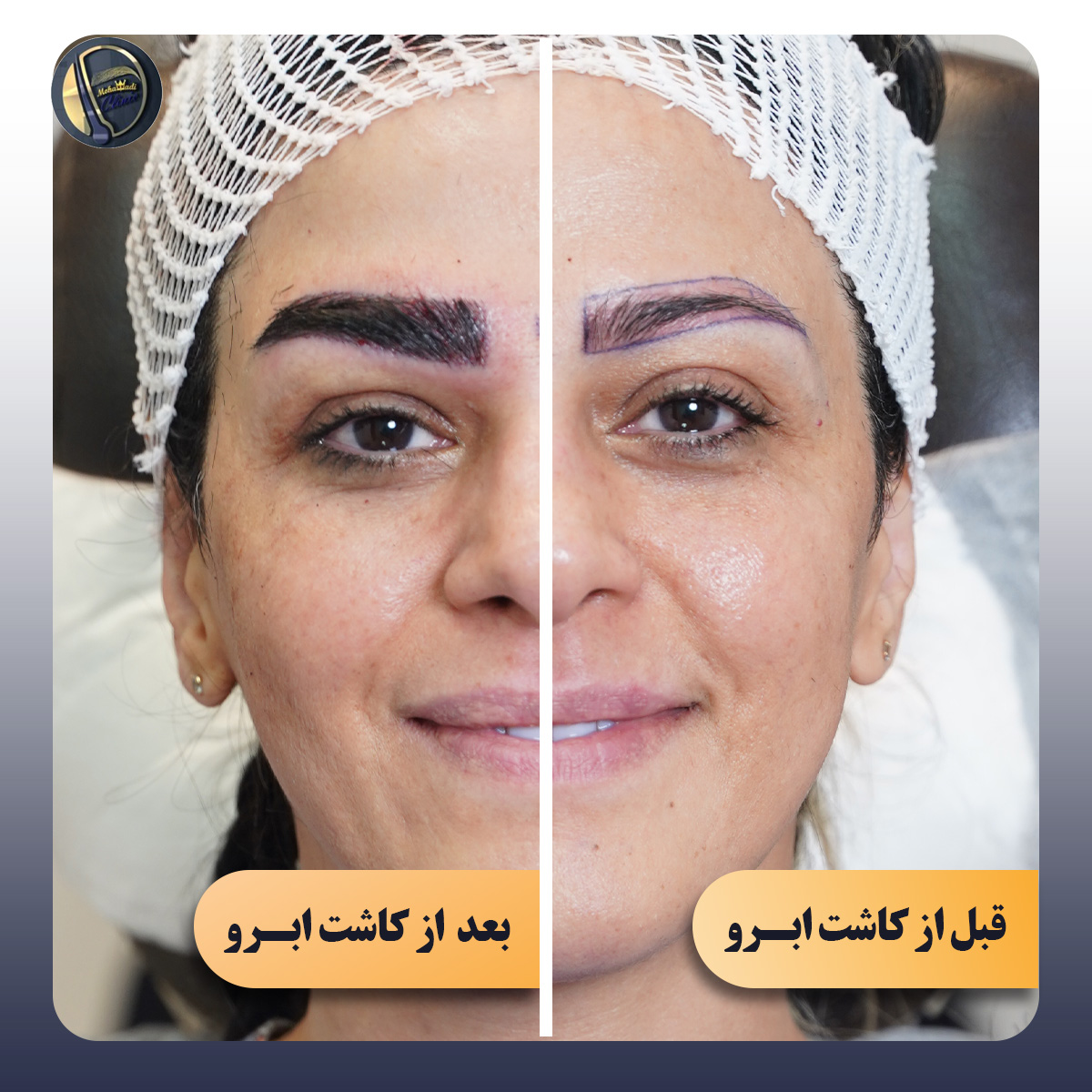 عکس قبل و بعد کاشت ابرو
