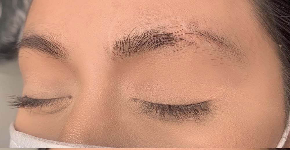 کاشت ابرو در جای زخم
