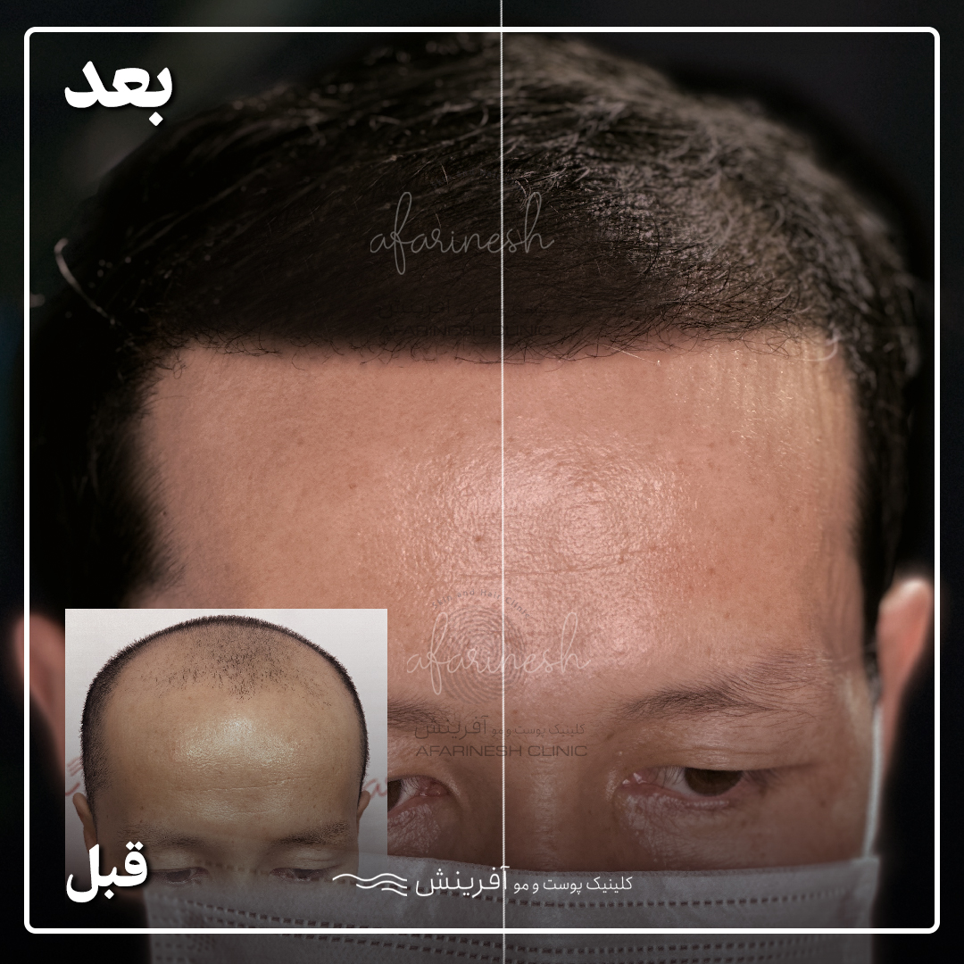 کاشت مو