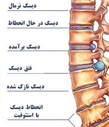دیسک بیرون زده