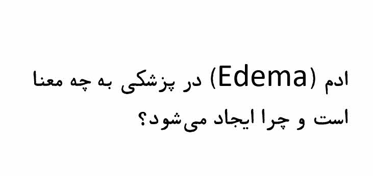 ادم (Edema)