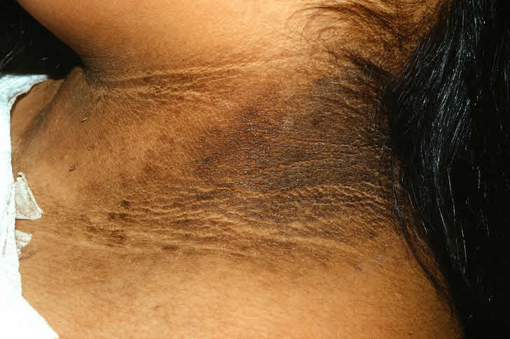 آکانتوز نیگریکانس - Acanthosis Nigricans