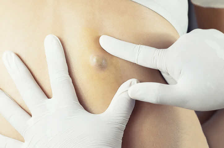 لیپوم - Lipoma