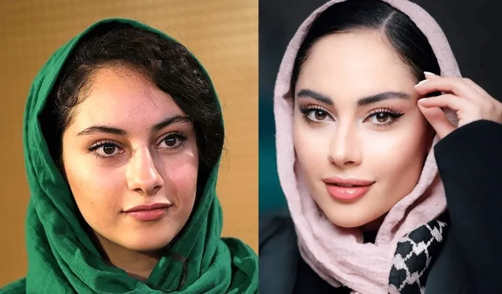 تزریق لب روسی ترلان پروانه