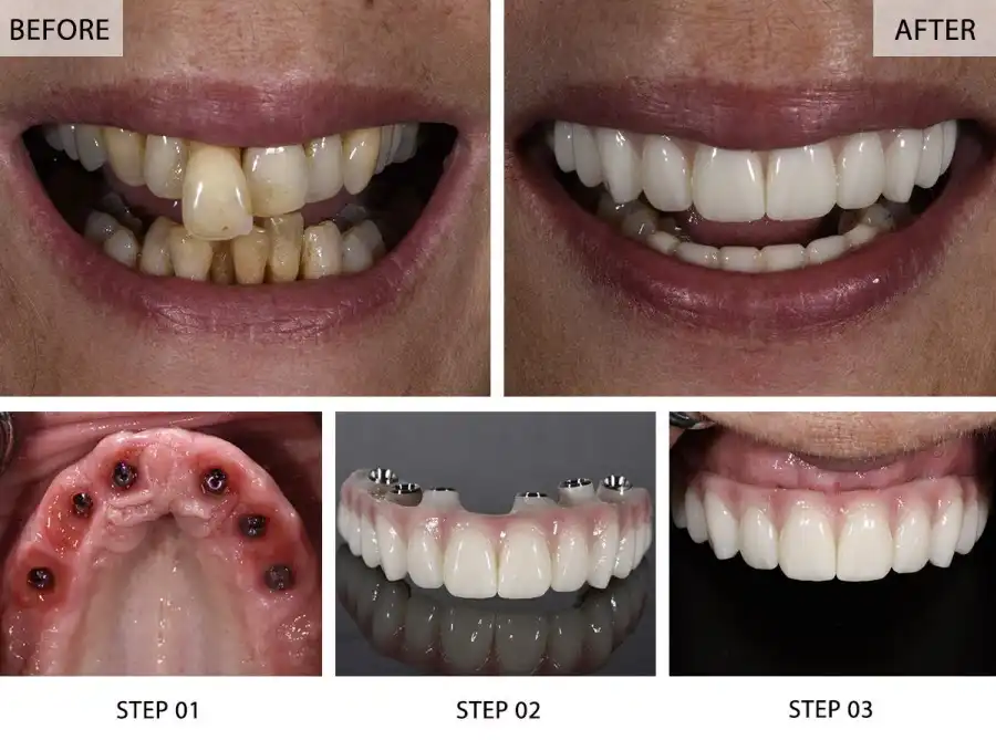 All-on-6 Dental Implants: Before and After Images (6 Galleries)