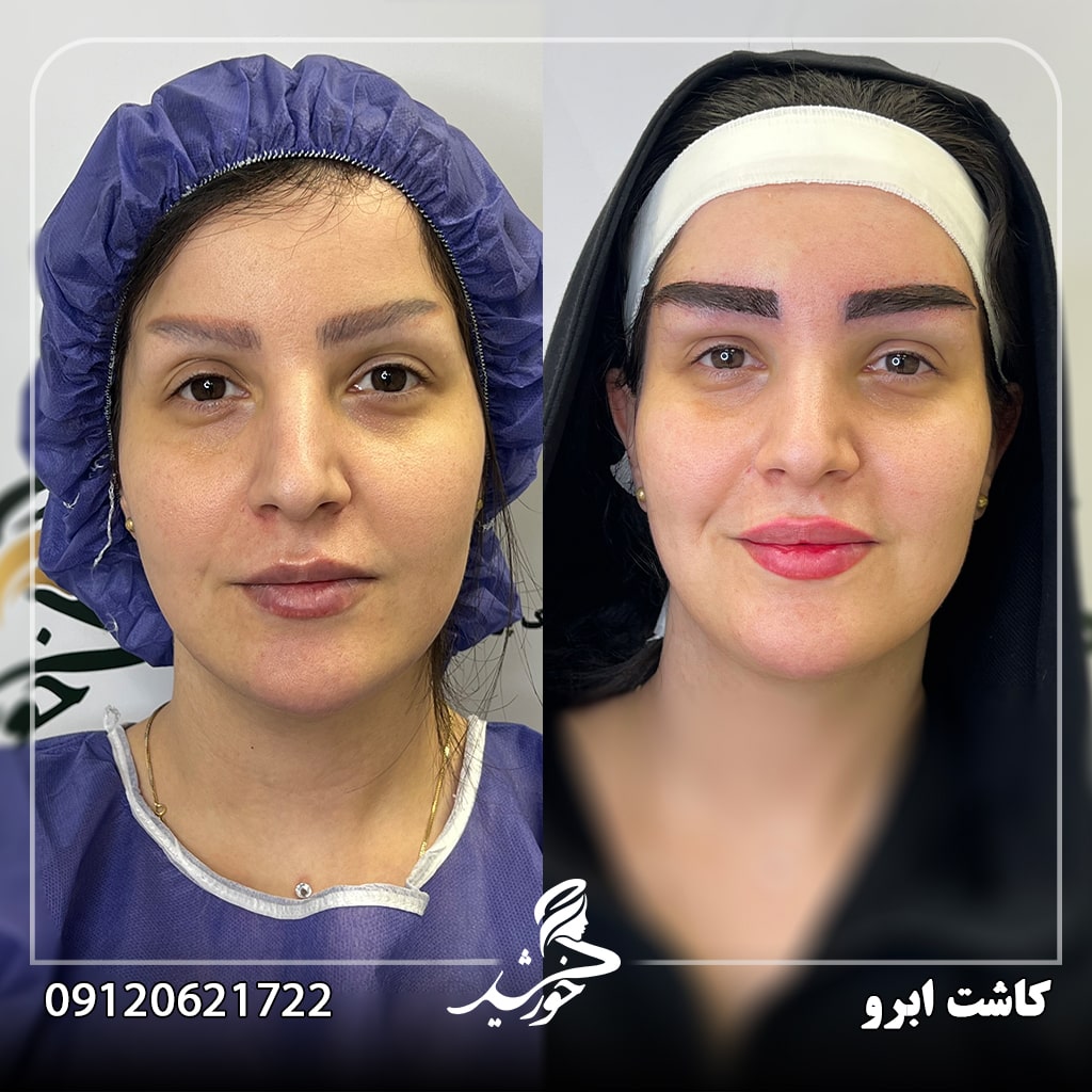 روش های کاشت ابرو