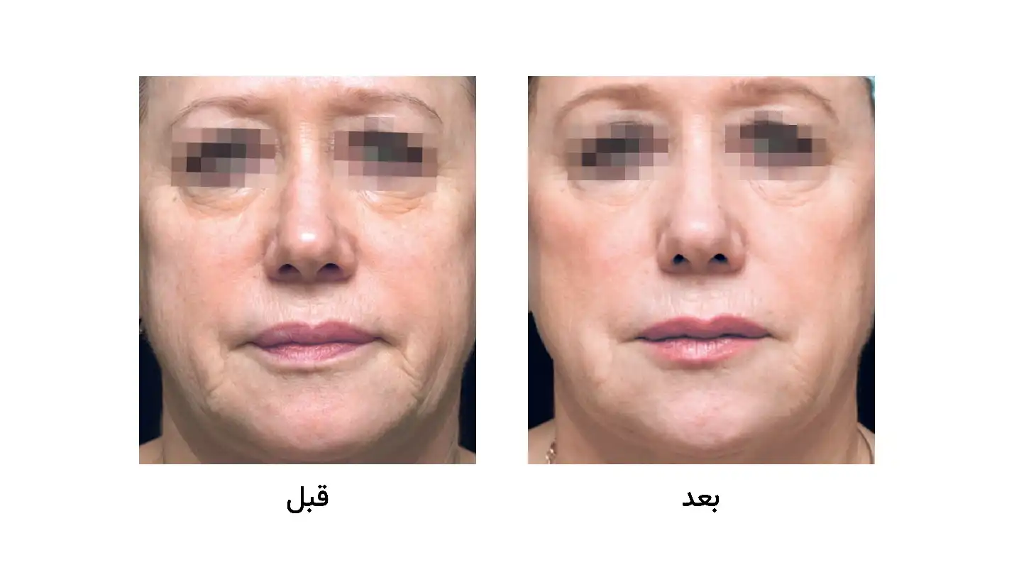 قبل و بعد تزریق پروفایلو