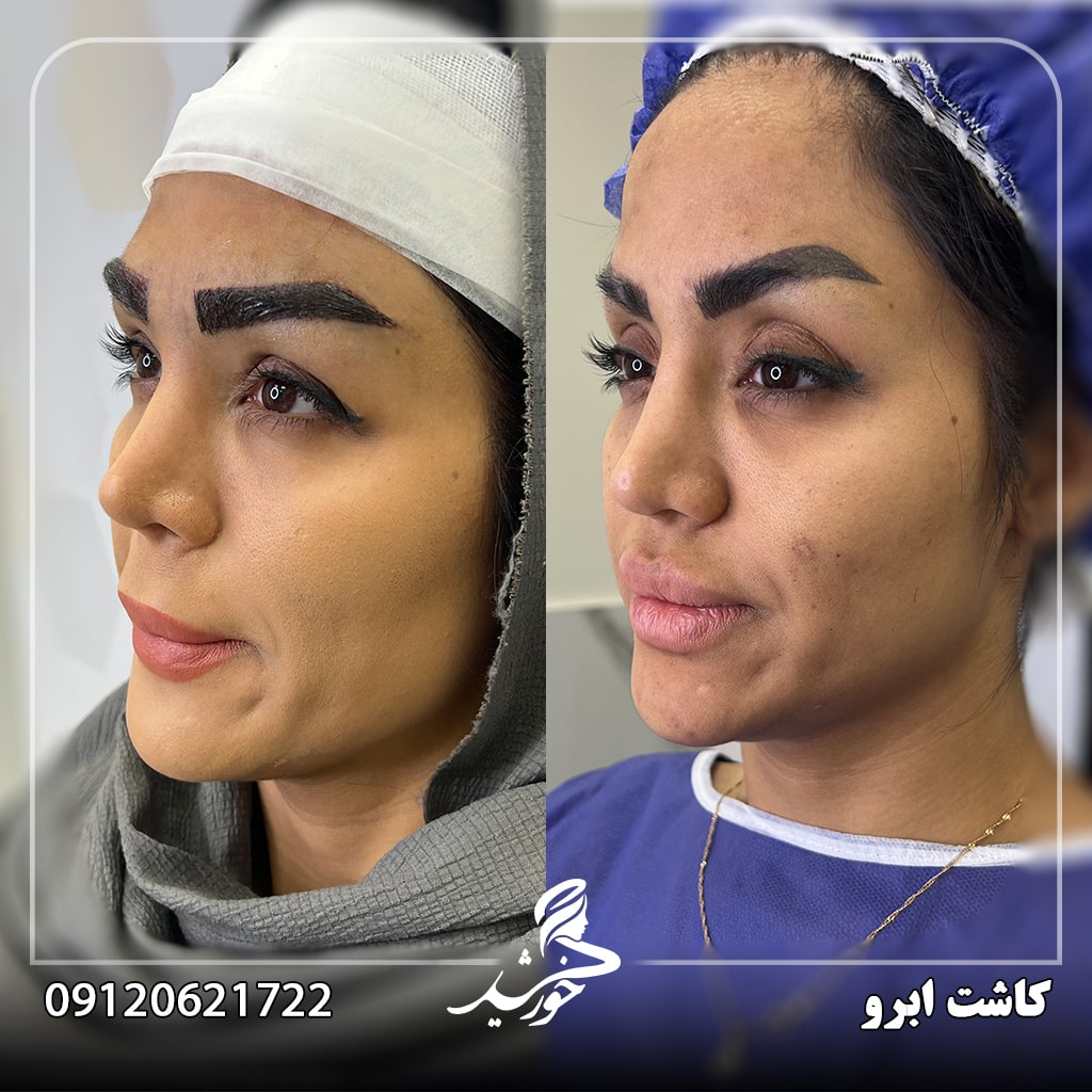 کاشت ابرو و مراقبت های بعد از آن