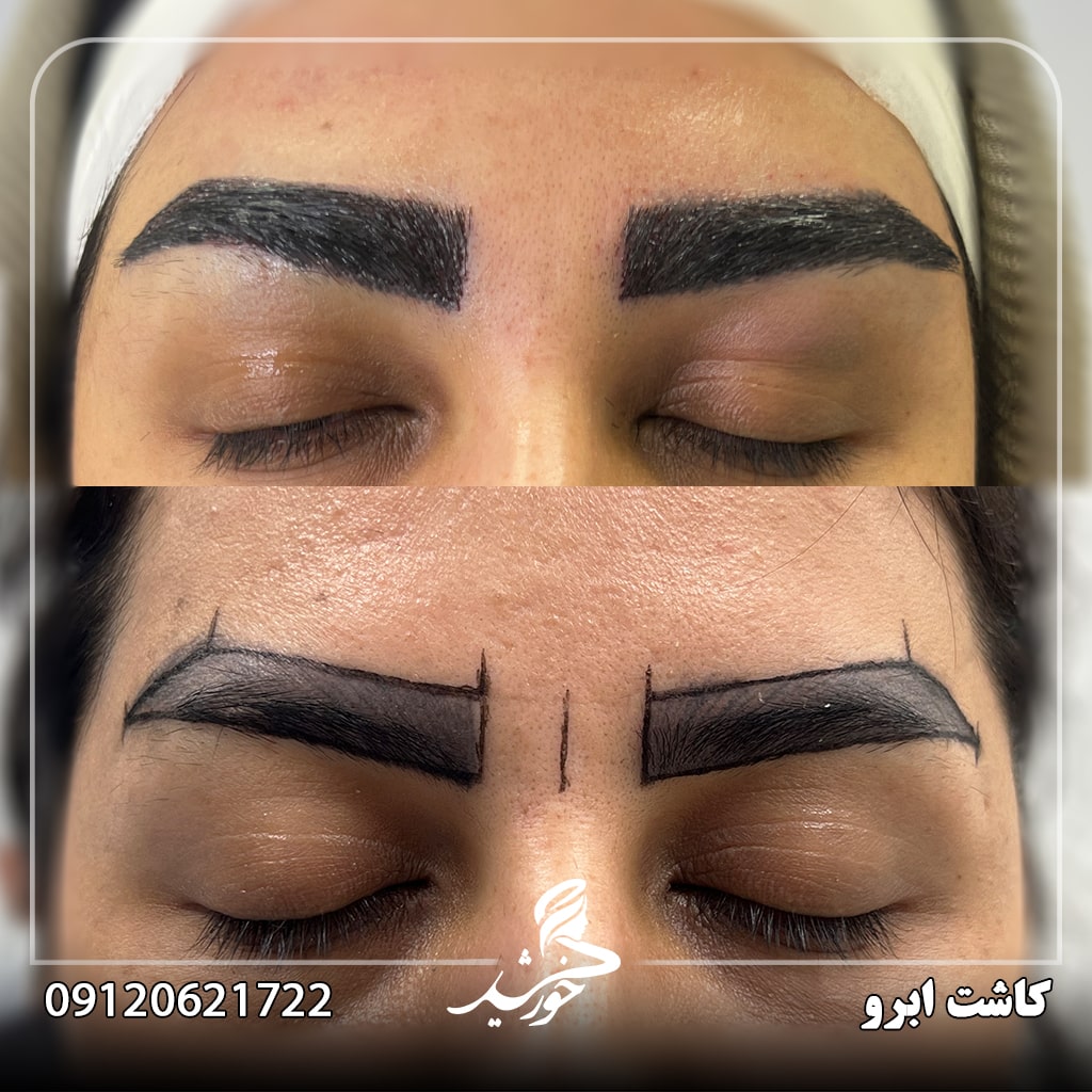 مزایای کاشت ابرو نسبت به تاتو