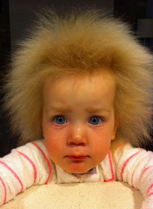 سندرم موی شیشهای یا «Uncombable Hair Syndrome»