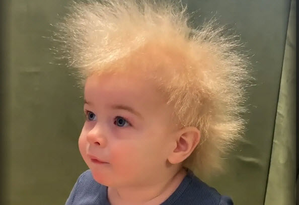 سندرم موی شیشهای یا «Uncombable Hair Syndrome»