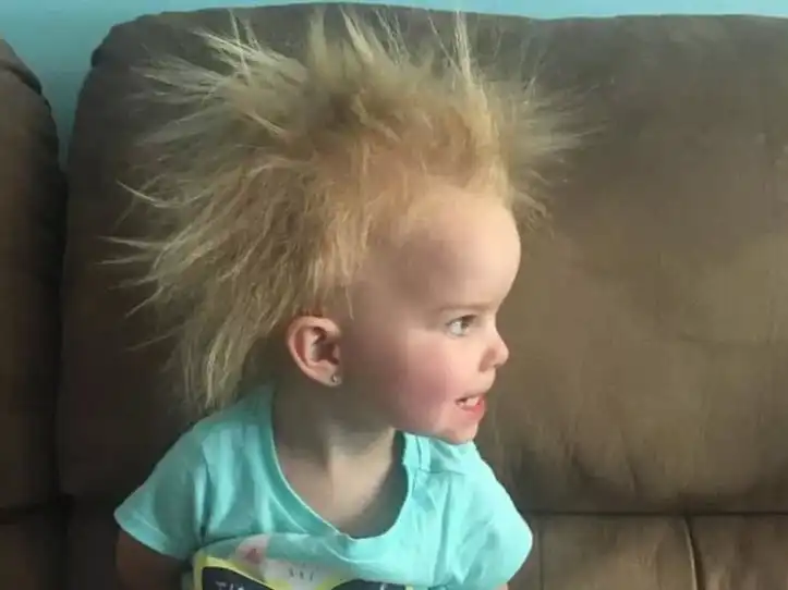 سندرم موی شیشهای یا «Uncombable Hair Syndrome»