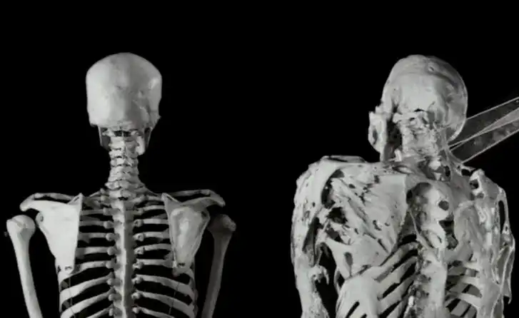 بیماری انسان سنگی یا Fibrodysplasia Ossificans Progressiva (FOP)