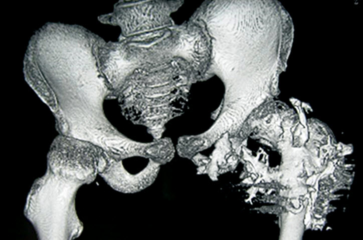 بیماری انسان سنگی یا Fibrodysplasia Ossificans Progressiva (FOP)