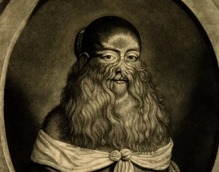 سندرم مرد گرگنما یا Hypertrichosis