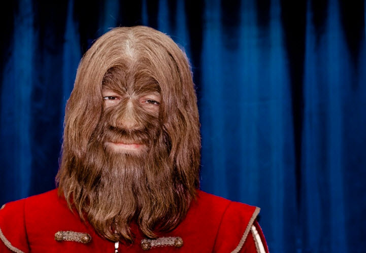 سندرم مرد گرگنما یا Hypertrichosis