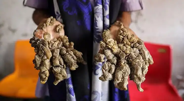 بیماری پوست درختی -اپیدرمودیسپلازی وروسیفورم
