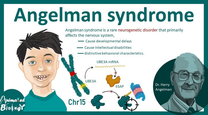 سندرم فرشته (Angelman Syndrome)