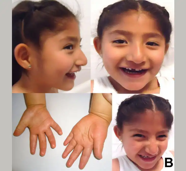 سندرم فرشته (Angelman Syndrome)