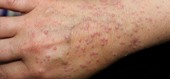 لیکن پلان (Lichen Planus)