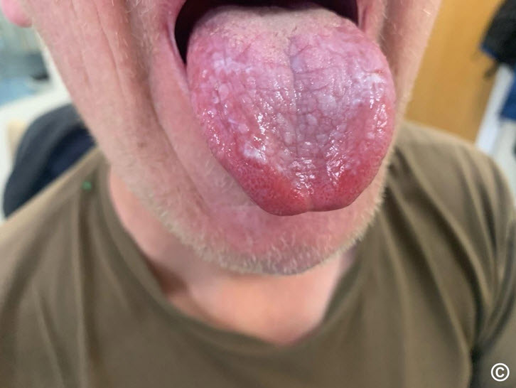 لیکن پلان (Lichen Planus)