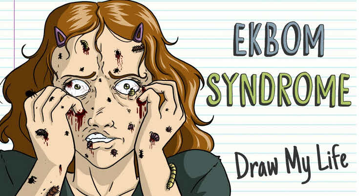 سندرم اکبوم Ekbom (توهم انگلزدگی)