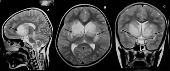 سندرم کلاور-بوسی یا Klüver-Bucy Syndrome (KBS)