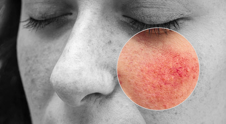 روزاسه (Rosacea)