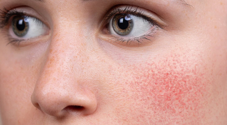 روزاسه (Rosacea)