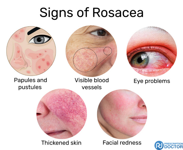روزاسه (Rosacea)