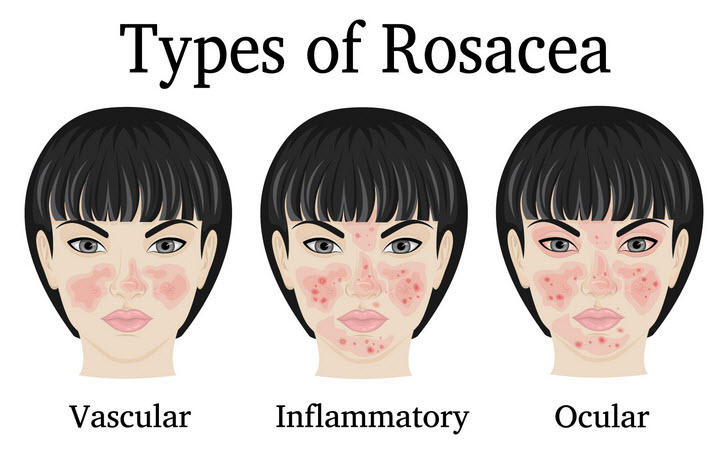 روزاسه (Rosacea)
