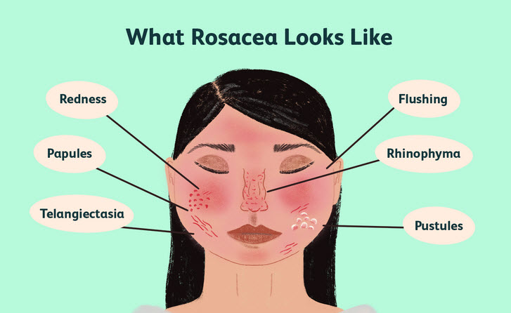 روزاسه (Rosacea)