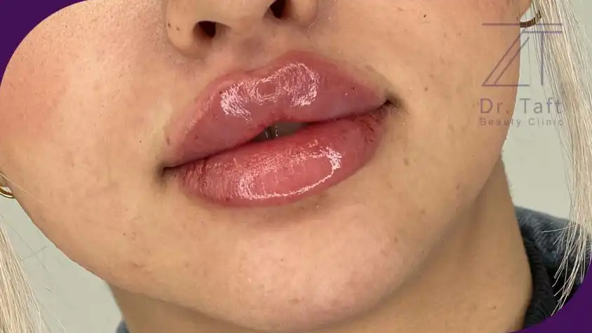 ژل لب عروسکی