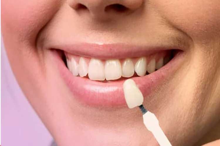 لمینت سرامیکی دندان