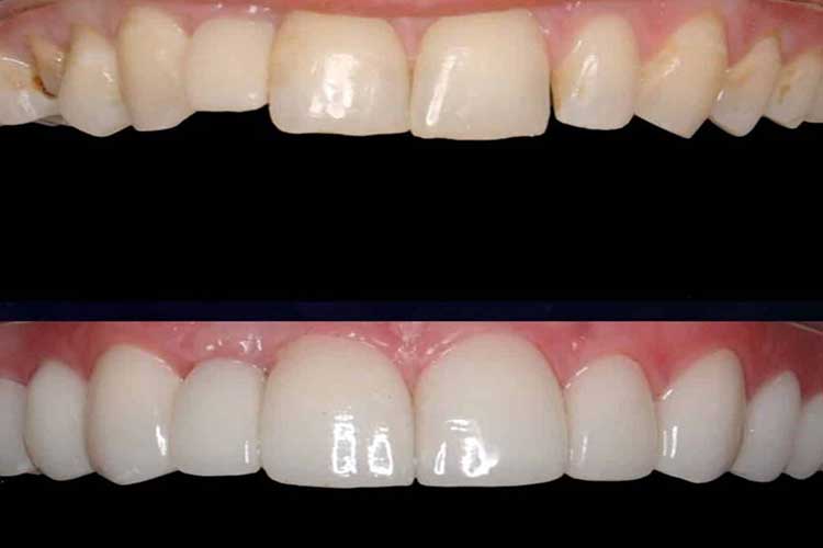 خدمات لمینت سرامیکی دندان