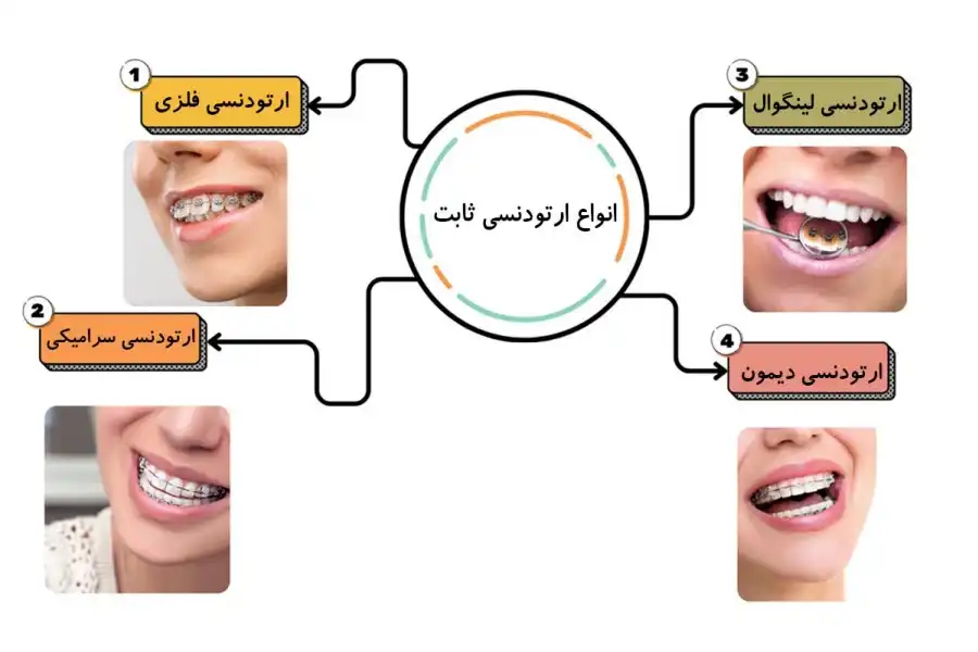 انواع ارتودنسی