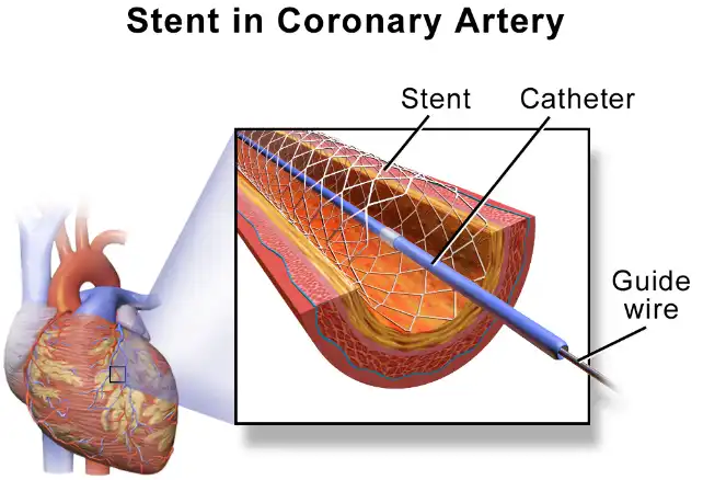 استنت (Stent) درون رگهای قلب