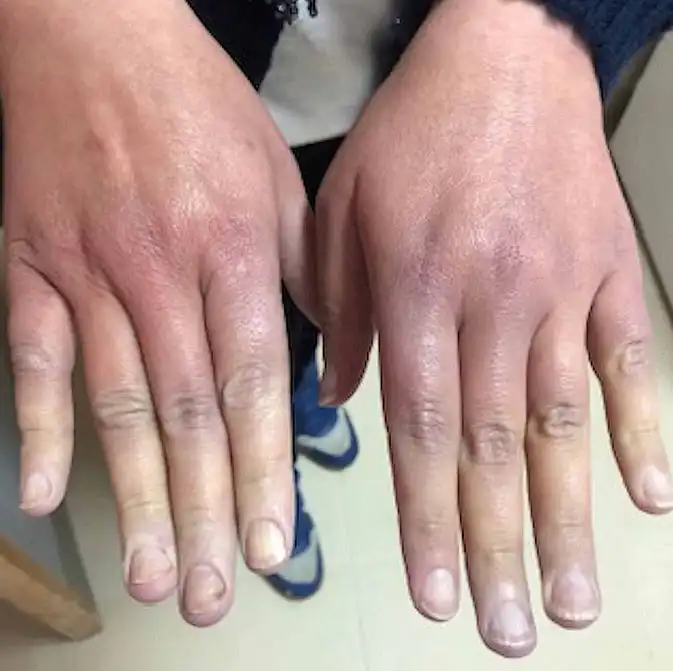 پدیده رینود (Raynaud’s Phenomenon)