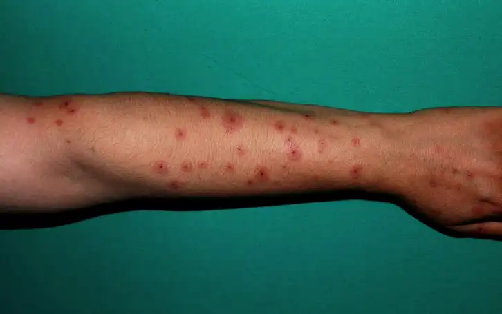 واکنشهای پوستی خطرناک به داروهای ضدصرع