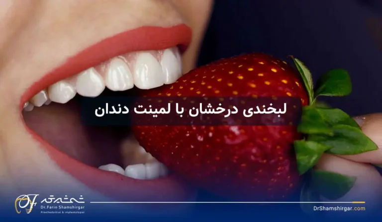 لمینت دندان