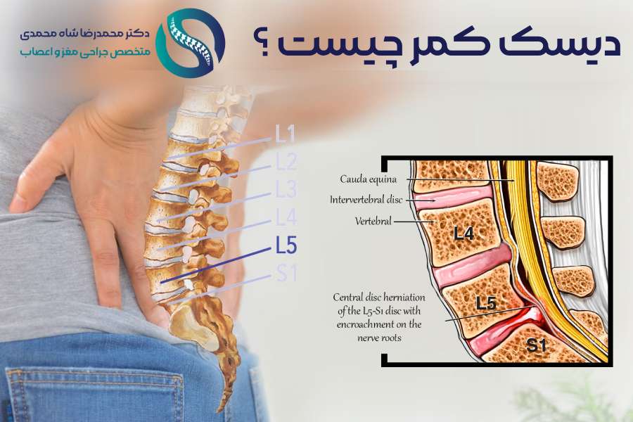 دیسک کمر چیست؟ - دکتر محمد رضا شاه محمدی