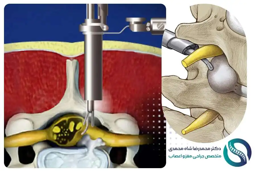 جراحی میکروسکوپی دیسک کمر - دکتر محمدرضا شاه محمدی