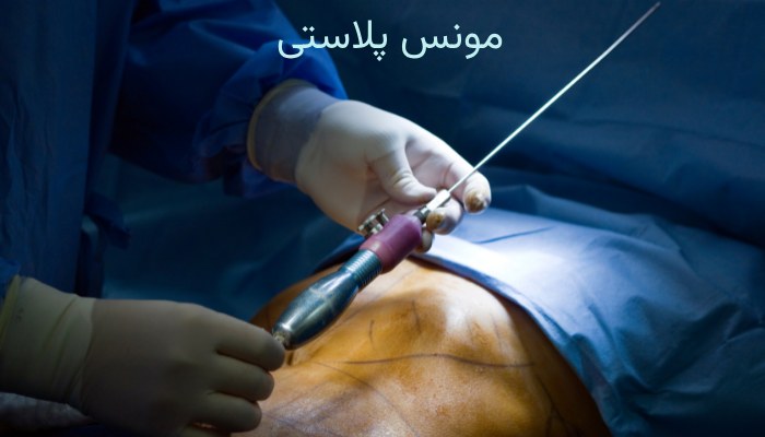  مونس‌پلاستی